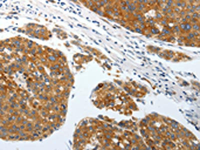 The image on the left is immunohistochemistry of paraffin-embedded Human liver cancer tissue using CSB-PA193383(SLC22A3 Antibody) at dilution 1/25, on the right is treated with synthetic peptide. (Original magnification: ×200)