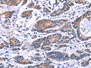 The image on the left is immunohistochemistry of paraffin-embedded Human colon cancer tissue using CSB-PA193423(SYT4 Antibody) at dilution 1/60, on the right is treated with fusion protein. (Original magnification: ×200)