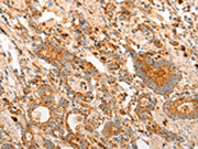The image on the left is immunohistochemistry of paraffin-embedded Human gastic cancer tissue using CSB-PA193428(CDKN1C Antibody) at dilution 1/15, on the right is treated with synthetic peptide. (Original magnification: ×200)