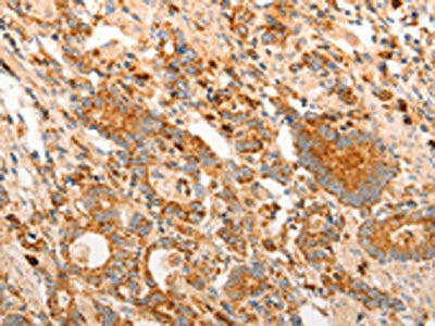 The image on the left is immunohistochemistry of paraffin-embedded Human gastic cancer tissue using CSB-PA193428(CDKN1C Antibody) at dilution 1/15, on the right is treated with synthetic peptide. (Original magnification: ×200)
