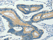 The image on the left is immunohistochemistry of paraffin-embedded Human colon cancer tissue using CSB-PA193476(ASB8 Antibody) at dilution 1/30, on the right is treated with fusion protein. (Original magnification: ×200)