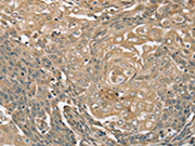 The image on the left is immunohistochemistry of paraffin-embedded Human cervical cancer tissue using CSB-PA193486(PIK3CD Antibody) at dilution 1/35, on the right is treated with synthetic peptide. (Original magnification: ×200)