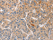 The image on the left is immunohistochemistry of paraffin-embedded Human liver cancer tissue using CSB-PA193639(CCL4 Antibody) at dilution 1/40, on the right is treated with fusion protein. (Original magnification: ×200)