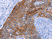 The image on the left is immunohistochemistry of paraffin-embedded Human cervical cancer tissue using CSB-PA193703(SGK2 Antibody) at dilution 1/20, on the right is treated with synthetic peptide. (Original magnification: ×200)
