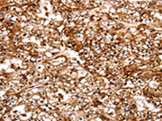 The image on the left is immunohistochemistry of paraffin-embedded Human renal cancer tissue using CSB-PA193846(SLC9A3R2 Antibody) at dilution 1/40, on the right is treated with synthetic peptide. (Original magnification: ×200)