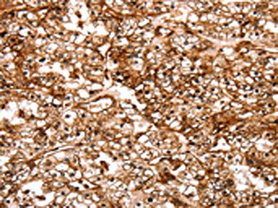 The image on the left is immunohistochemistry of paraffin-embedded Human renal cancer tissue using CSB-PA193846(SLC9A3R2 Antibody) at dilution 1/40, on the right is treated with synthetic peptide. (Original magnification: ×200)