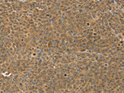 The image on the left is immunohistochemistry of paraffin-embedded Human ovarian cancer tissue using CSB-PA193960(MED15 Antibody) at dilution 1/30, on the right is treated with synthetic peptide. (Original magnification: ×200)