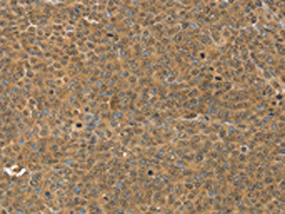 The image on the left is immunohistochemistry of paraffin-embedded Human ovarian cancer tissue using CSB-PA193960(MED15 Antibody) at dilution 1/30, on the right is treated with synthetic peptide. (Original magnification: ×200)