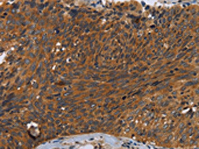 The image on the left is immunohistochemistry of paraffin-embedded Human cervical cancer tissue using CSB-PA193987(CSF2RA Antibody) at dilution 1/35, on the right is treated with synthetic peptide. (Original magnification: ×200)