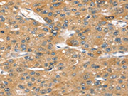 The image on the left is immunohistochemistry of paraffin-embedded Human liver cancer tissue using CSB-PA194090(SORT1 Antibody) at dilution 1/40, on the right is treated with synthetic peptide. (Original magnification: ×200)