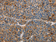 The image on the left is immunohistochemistry of paraffin-embedded Human liver cancer tissue using CSB-PA194113(AMBP Antibody) at dilution 1/55, on the right is treated with fusion protein. (Original magnification: ×200)