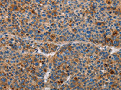 The image on the left is immunohistochemistry of paraffin-embedded Human liver cancer tissue using CSB-PA194113(AMBP Antibody) at dilution 1/55, on the right is treated with fusion protein. (Original magnification: ×200)