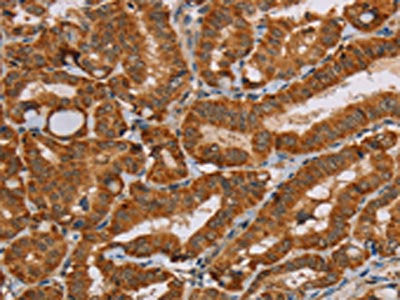 The image on the left is immunohistochemistry of paraffin-embedded Human thyroid cancer tissue using CSB-PA194131(MSR1 Antibody) at dilution 1/25, on the right is treated with fusion protein. (Original magnification: ×200)