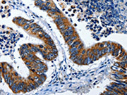 The image on the left is immunohistochemistry of paraffin-embedded Human colon cancer tissue using CSB-PA194222(LAMA1 Antibody) at dilution 1/25, on the right is treated with synthetic peptide. (Original magnification: ×200)