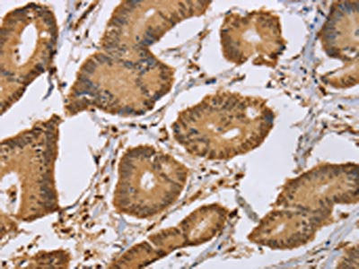 The image on the left is immunohistochemistry of paraffin-embedded Human colon cancer tissue using CSB-PA194515(CEL Antibody) at dilution 1/50, on the right is treated with synthetic peptide. (Original magnification: ×200)