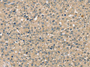 The image on the left is immunohistochemistry of paraffin-embedded Human breast cancer tissue using CSB-PA194569(SMAGP Antibody) at dilution 1/40, on the right is treated with synthetic peptide. (Original magnification: ×200)