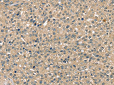 The image on the left is immunohistochemistry of paraffin-embedded Human breast cancer tissue using CSB-PA194569(SMAGP Antibody) at dilution 1/40, on the right is treated with synthetic peptide. (Original magnification: ×200)