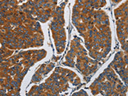 The image on the left is immunohistochemistry of paraffin-embedded Human breast cancer tissue using CSB-PA194613(APEH Antibody) at dilution 1/30, on the right is treated with synthetic peptide. (Original magnification: ×200)