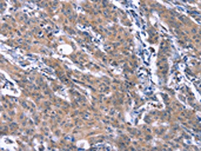 The image on the left is immunohistochemistry of paraffin-embedded Human gastic cancer tissue using CSB-PA195094(ESPL1 Antibody) at dilution 1/40, on the right is treated with synthetic peptide. (Original magnification: ×200)