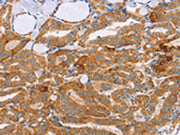 The image on the left is immunohistochemistry of paraffin-embedded Human thyroid cancer tissue using CSB-PA195161(CARD6 Antibody) at dilution 1/60, on the right is treated with synthetic peptide. (Original magnification: ×200)