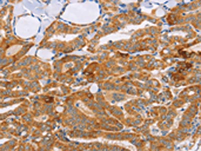 The image on the left is immunohistochemistry of paraffin-embedded Human thyroid cancer tissue using CSB-PA195161(CARD6 Antibody) at dilution 1/60, on the right is treated with synthetic peptide. (Original magnification: ×200)