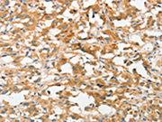 The image on the left is immunohistochemistry of paraffin-embedded Human thyroid cancer tissue using CSB-PA195221(UCHL5 Antibody) at dilution 1/20, on the right is treated with fusion protein. (Original magnification: ×200)