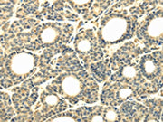 The image on the left is immunohistochemistry of paraffin-embedded Human thyroid cancer tissue using CSB-PA195244(WDR45B Antibody) at dilution 1/40, on the right is treated with synthetic peptide. (Original magnification: ×200)