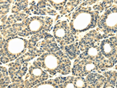 The image on the left is immunohistochemistry of paraffin-embedded Human thyroid cancer tissue using CSB-PA195244(WDR45B Antibody) at dilution 1/40, on the right is treated with synthetic peptide. (Original magnification: ×200)