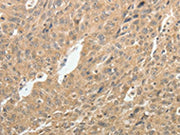 The image on the left is immunohistochemistry of paraffin-embedded Human ovarian cancer tissue using CSB-PA195276(TH Antibody) at dilution 1/10, on the right is treated with synthetic peptide. (Original magnification: ×200)