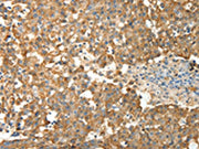 The image on the left is immunohistochemistry of paraffin-embedded Human breast cancer tissue using CSB-PA195573(PRDX3 Antibody) at dilution 1/50, on the right is treated with fusion protein. (Original magnification: ×200)
