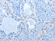 The image on the left is immunohistochemistry of paraffin-embedded Human cervical cancer tissue using CSB-PA195686(NAE1 Antibody) at dilution 1/20, on the right is treated with fusion protein. (Original magnification: ×200)