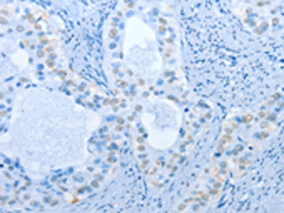 The image on the left is immunohistochemistry of paraffin-embedded Human cervical cancer tissue using CSB-PA195686(NAE1 Antibody) at dilution 1/20, on the right is treated with fusion protein. (Original magnification: ×200)