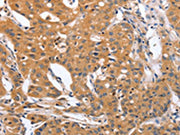 The image on the left is immunohistochemistry of paraffin-embedded Human lung cancer tissue using CSB-PA195809(BLNK Antibody) at dilution 1/50, on the right is treated with synthetic peptide. (Original magnification: ×200)