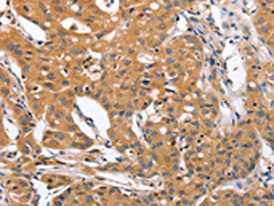 The image on the left is immunohistochemistry of paraffin-embedded Human lung cancer tissue using CSB-PA195809(BLNK Antibody) at dilution 1/50, on the right is treated with synthetic peptide. (Original magnification: ×200)
