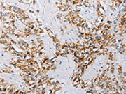 The image on the left is immunohistochemistry of paraffin-embedded Human prostate cancer tissue using CSB-PA195861(ATG4C Antibody) at dilution 1/25, on the right is treated with fusion protein. (Original magnification: ×200)