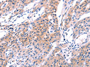 The image on the left is immunohistochemistry of paraffin-embedded Human lung cancer tissue using CSB-PA195869(VWF Antibody) at dilution 1/50, on the right is treated with fusion protein. (Original magnification: ×200)