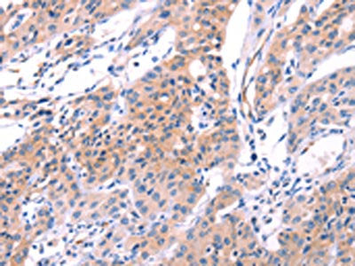The image on the left is immunohistochemistry of paraffin-embedded Human lung cancer tissue using CSB-PA195869(VWF Antibody) at dilution 1/50, on the right is treated with fusion protein. (Original magnification: ×200)