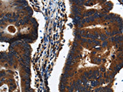The image on the left is immunohistochemistry of paraffin-embedded Human colon cancer tissue using CSB-PA195923(KLHL8 Antibody) at dilution 1/20, on the right is treated with synthetic peptide. (Original magnification: ×200)