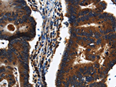The image on the left is immunohistochemistry of paraffin-embedded Human colon cancer tissue using CSB-PA195923(KLHL8 Antibody) at dilution 1/20, on the right is treated with synthetic peptide. (Original magnification: ×200)
