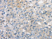 The image on the left is immunohistochemistry of paraffin-embedded Human breast cancer tissue using CSB-PA196085(THAP2 Antibody) at dilution 1/20, on the right is treated with fusion protein. (Original magnification: ×200)