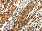 The image on the left is immunohistochemistry of paraffin-embedded Human gastric cancer tissue using CSB-PA196094(BCLAF1 Antibody) at dilution 1/25, on the right is treated with synthetic peptide. (Original magnification: ×200)