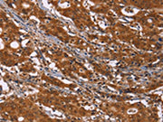 The image on the left is immunohistochemistry of paraffin-embedded Human gastic cancer tissue using CSB-PA196180(DCBLD2 Antibody) at dilution 1/50, on the right is treated with fusion protein. (Original magnification: ×200)