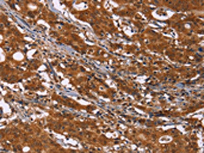 The image on the left is immunohistochemistry of paraffin-embedded Human gastic cancer tissue using CSB-PA196180(DCBLD2 Antibody) at dilution 1/50, on the right is treated with fusion protein. (Original magnification: ×200)