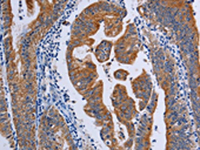 The image on the left is immunohistochemistry of paraffin-embedded Human gastic cancer tissue using CSB-PA196351(ACP6 Antibody) at dilution 1/50, on the right is treated with fusion protein. (Original magnification: ×200)