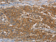 The image is immunohistochemistry of paraffin-embedded Human gastic cancer tissue using CSB-PA196408(CFL1 Antibody) at dilution 1/30. (Original magnification: 200)