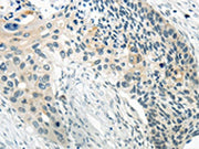 The image on the left is immunohistochemistry of paraffin-embedded Human esophagus cancer tissue using CSB-PA196485(WNT2B Antibody) at dilution 1/20, on the right is treated with synthetic peptide. (Original magnification: ×200)