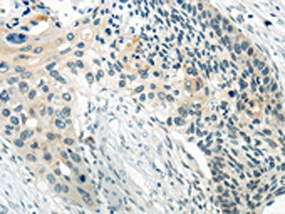 The image on the left is immunohistochemistry of paraffin-embedded Human esophagus cancer tissue using CSB-PA196485(WNT2B Antibody) at dilution 1/20, on the right is treated with synthetic peptide. (Original magnification: ×200)