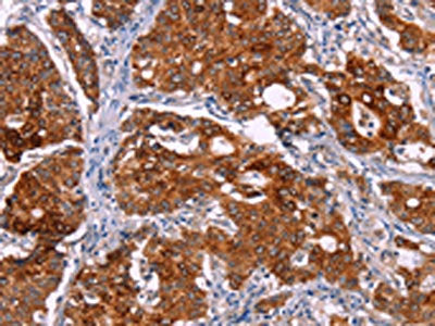 The image on the left is immunohistochemistry of paraffin-embedded Human gastic cancer tissue using CSB-PA196525(BCR Antibody) at dilution 1/15, on the right is treated with synthetic peptide. (Original magnification: ×200)