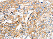 The image on the left is immunohistochemistry of paraffin-embedded Human esophagus cancer tissue using CSB-PA196561(SLC22A17 Antibody) at dilution 1/30, on the right is treated with synthetic peptide. (Original magnification: ×200)