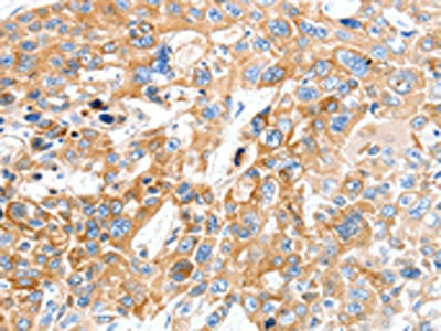 The image on the left is immunohistochemistry of paraffin-embedded Human esophagus cancer tissue using CSB-PA196561(SLC22A17 Antibody) at dilution 1/30, on the right is treated with synthetic peptide. (Original magnification: ×200)